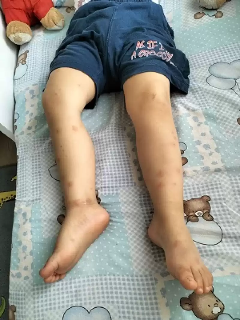 Sivrisinekler Hastanelik Etmeye Başladı