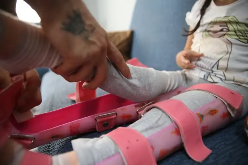 Doğuştan Ayrık Omurga Hastası Yağmur Tek Başına Yürüyebileceği Günün Hayalini Kuruyor