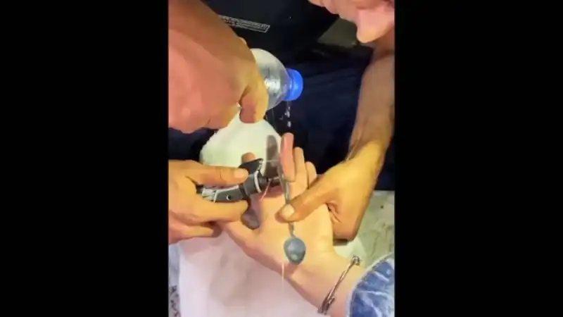 Hatay’da Parmağa Sıkışan Yüzük Çıkarıldı