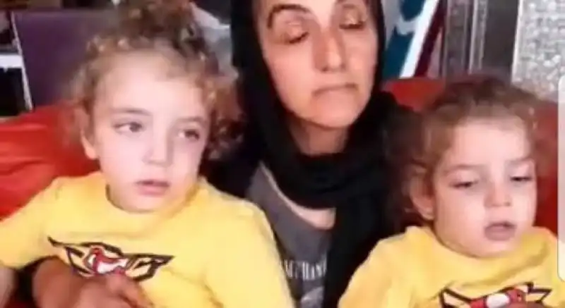 Siyam İkizlerin Hayata Tutunma Mücadeleleri Yarım Kaldı!